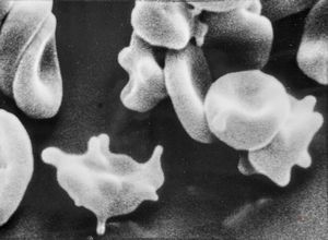 M,30y. | blood - dyserythropoetic anemia M,30y. | blood - dyserythropoetic anemia
